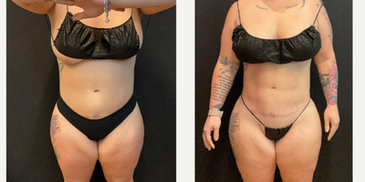 35-44 year old woman treated with Brazilian Butt Lift, Abdominal Etching - BBL + HD Lipo by Dr. Johnny Franco in Austin, TX
