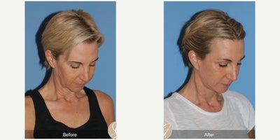 56 year old woman treated with Deep Plane Facelift, Neck Lift, Eyelid Surgery, MACS Facelift - 56 year old woman treated with Deep Plane Face and Neck Lift, Fat Grafting to Face, Lower Blepharoplasty skin Pinch, MAC