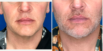 Patient treated with Endolift - Patient treated with Endolift