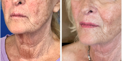 Patient treated with Endolift - Patient treated with Endolift