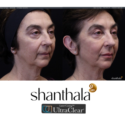 UltraClear Laser & Laser-Coring by Dr. Shanthala - Laser-Coring with UltraClear Laser was performed after Cheek volume correction, under eye fillers & lip fillers on the same day by Dr. Shanthala
