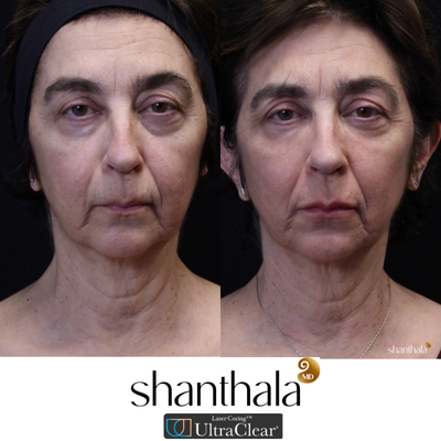 UltraClear Laser & Laser-Coring by Dr. Shanthala - Laser-Coring with UltraClear Laser was performed after Cheek volume correction, under eye fillers & lip fillers on the same day by Dr. Shanthala