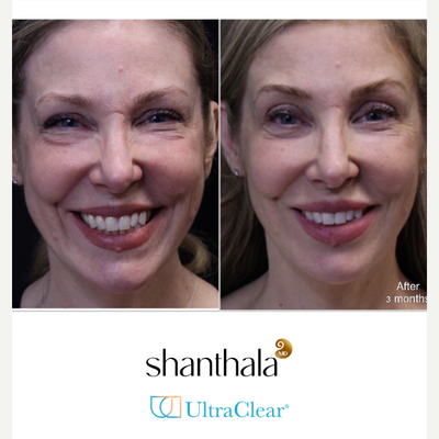 UltraClear Laser, Skin Rejuvenation, Laser Resurfacing, Fractional Laser by Dr. Shanthala - Laser-Coring with UltraClear laser after removal of under eye fillers resulted in peri-orbital rejuvenation, and fuller cheeks & more refreshed, youthful results performed by MD only.
