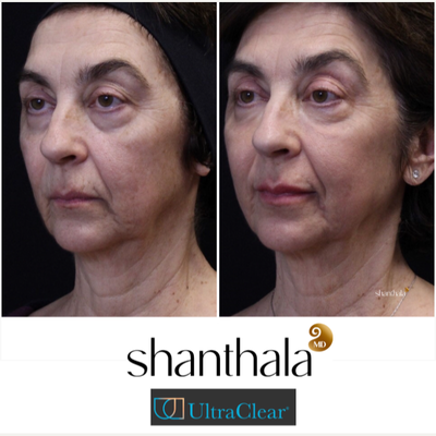 UltraClear Laser & Laser-Coring by Dr. Shanthala - Laser-Coring with UltraClear Laser was performed after Cheek volume correction, under eye fillers & lip fillers on the same day by Dr. Shanthala
