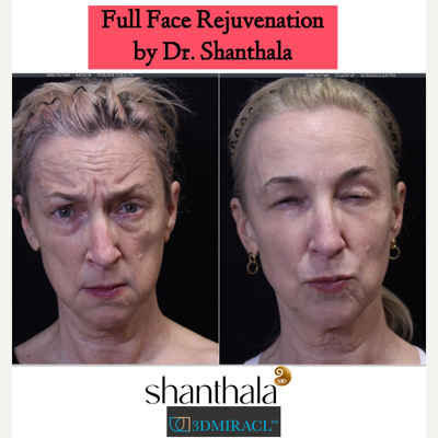 3DMIRACL Laser procedure by Dr. Shanthala - 3DMIRACL laser is an excellent choice for long-term skin health, superficial skin resurfacing with no numbing.