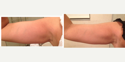 35-44 year old woman treated with TriPollar - after 6 weeks of Tripollar