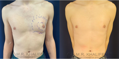 Man treated with Gynecomastia Surgery - This is a revision gynecomastia surgery. Patient was treated elsewhere with liposuction and an attempt at lateral incision approach to remove the gland. Much gland remained, as well as newly formed scar tissue at the nine-month mark, so we retreated via a revision surgery with direct access via the areola.