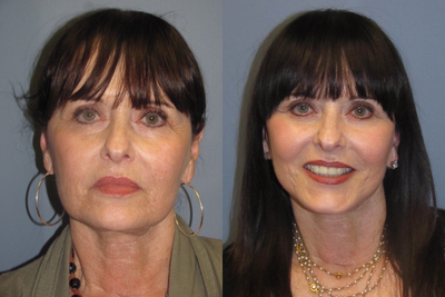 62 year old Blue Peel - 	Blue Peel following a Lite Lift procedure .