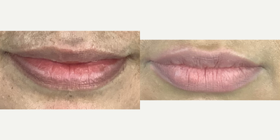 35-44 year old woman treated with Lip Fillers - Lip filler before and one month after on female showing a fuller upper lip