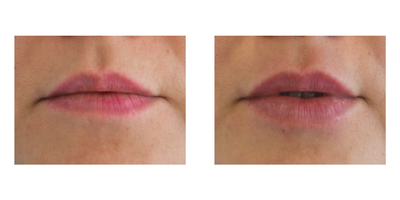 35-44 year old woman treated with Lip Fillers - For the lips volumination, an application of hyaluronic acid is performed with personalized techniques to restore or give volume and elasticity in a natural way to the lips, always respecting naturalness and avoiding excesses or very voluminous lips.The results are progressive, they can be seen from the moment of application, but after 15 days the final result is reflected.