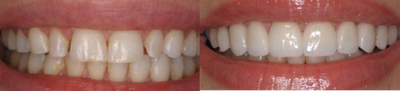 10 Porcelain Veneers - 
	Patient recieved 10 porcelain veneers