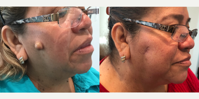 55-64 year old woman treated with Mole Removal - Mole Removal