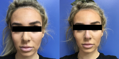 25-34 year old woman treated with Nonsurgical Nose Job - This patient had volume injected into her nose to help with the appearance.