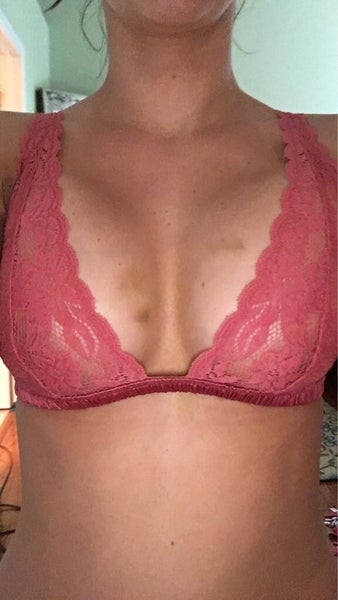 5'2 111 lbs. from 32A to 32E 480UHP Silicone & Splenectomy Scar