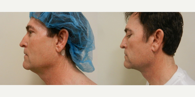 Man treated with Facial Fat Transfer - Man treated with Facial Fat Transfer to the eyes and Neck Lift.
