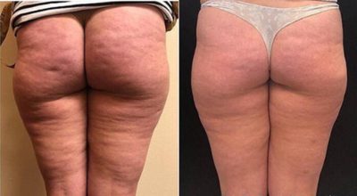 Woman treated with BodyFX - Woman treated with BodyFX