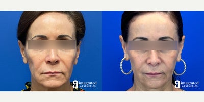 55-64 year old woman treated with Radiesse - The patient is a 58 year-old female who had concerns with lost facial volume. Dr. Chiang used Radiesse to treat the midface, chin and lips. The after results are 2 weeks post treatment.