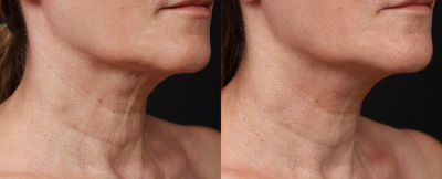eMatrix for Skin Tightening - Patient had a series of eMatrix treatments to tighten and resurface her neck.