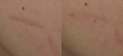 Traumatic Facial Scar after 6 Treatments with the 1540 Lux Fractional Laser - 
	Traumatic Facial Scar after 6 Treatments with the 1540 Lux Fractional Laser.&nbsp;

