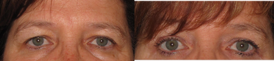 Female Ultherapy for brow lift - Patient was considering an upper blepharoplasty but did not want surgery or down time.  She is very pleased with her Ultherapy brow lift.