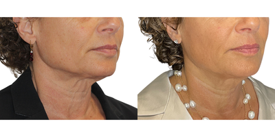 Sofwave: mid face and neck - This beautiful patient wanted to tighten and lift the skin. Her results are shown 6 months after her Sofwave treatment.