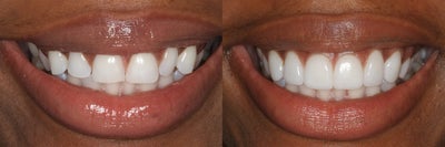 Durathin Minimal Prep Veneers - Smile enhanced with 10 Durathin Veneers, Gingival contouring, Whitening, and Contouring of lower incisors.