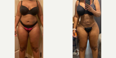 Woman treated with Brazilian Butt Lift - Woman treated with Brazilian Butt Lift as well asLiposuction