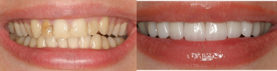 Porcelain Veneers - 
	Smile Makeover with 8 Porcelain Veneers.
