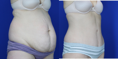 35-44 year old woman treated with Diastasis Recti Repair  - 6m post abdominoplasty and muscle repair and 360 liposuction