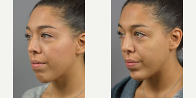 Woman treated with Nonsurgical Nose Job, Botox, Dermal Fillers - Facial Asymmetry and contour is natural and makes each face unique. While most imperfections go unnoticed by the outside world. Often times we treat with surgical interventions but for a temporary adjustment with just as much impact the use of Botox and Filler can be used. Non-surgical Rhinoplasty by Dr. James Marotta complimented by filler injections to the chin.