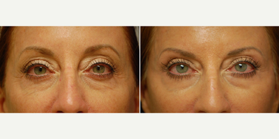 45-54 year old woman treated with Phenol Peel - Around the eyes, a diluted version of the deep chemical peel is used to rejuvenate the skin. Notice the softening and smoothing of the skin.