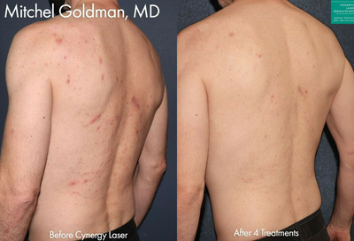 Man treated with Pulsed Dye Laser - Cynergy laser to treat port wine stain on neck by Dr. Goldman.