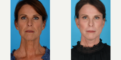 Woman treated with Laser Resurfacing - Woman treated with Facelift, Neck Lift, Brow Lift, Full Face Laser (Erbium Sciton Laser), and Facial Fat Transfer, shown 2 months post op.