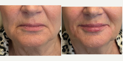 65-74 year old woman treated with Dermal Fillers, Restylane Lyft, Restylane Defyne, Restylane Contour, Voluma, Juvederm - 70 year old female wanting the marionette lines (oral commisures) to be improved.   Pt received a combination of fillers to soften these lines with a 25g cannula