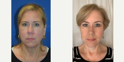45-54 year old woman treated with Facelift - Before & After: A-Lift - Dr. Almonte's signature facelift.