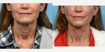 45-54 year old woman treated with CO2 Laser - lower face & neck lift, CO2 laser skin resurfacing.