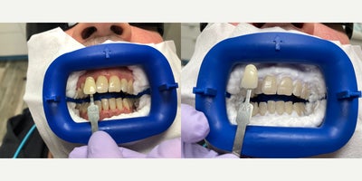 35-44 year old man treated with Zoom Whitening - Patient came in for teeth whitening. We achieved these results with 3 sessions in one day, taking a total time of 90 minutes.