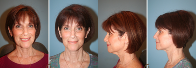 Lower Face Lift and Neck Lift performed with Local Anesthesia  - This patient was looking for a procedure that would given her a more defined jawline but remain natural looking after surgery. She was referred to Dr. Kevin Sadati by a friend of hers that was a past patient of his. &nbsp;During the consultation Dr. Kevin Sadati suggested a lower face and neck lift in order to obtain the patient's desired results. &nbsp;The entire face lift procedure took about two hours. &nbsp;The facelift was done with local anesthesia and oral sedation, without going under any general anesthesia. Recovery time was minimal and the procedure was much more cost effective then it would have been under general anesthesia.&nbsp;