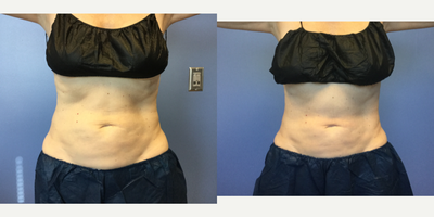 55-64 year old woman treated with CoolTone - 59 year old woman who had 4 cool tone treatments on her abdomen. This after photo is 30 days after her 4th treatment was complete.