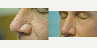 55-64 year old man treated with laser resurfacing - Laser resurfacing with CO2RE laser.