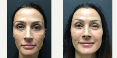35-44 year old woman treated with Clear & Brilliant - Before and after 1 Clear & Brilliant Permea treatment