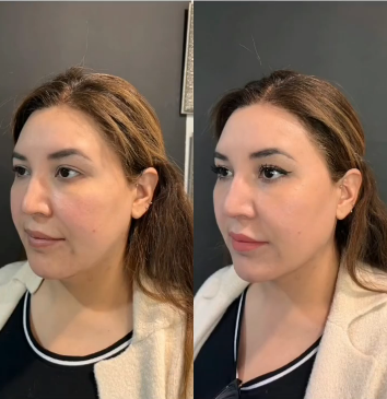 Woman treated with Cheek Lift - Woman treated with Cheek Lift