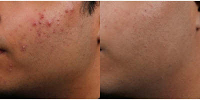 Man treated with AviClear - 3 months after final treatment session.
