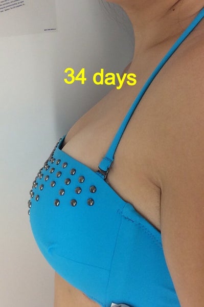 22 Years Old, No Kids, 34A to 34DD, 450cc Silicone Implants 