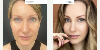 35-44 year old woman treated with Facelift - Facelift