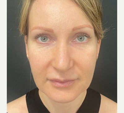 35-44 year old woman treated with Facelift - Facelift