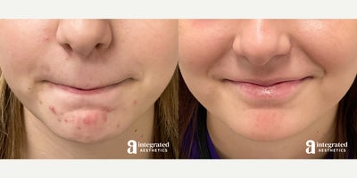 17 or under year old woman treated with Accutane - The patient is a 15 year-old female who had concerns with severe acne located on the forehead and chin. Dr. Chiang treated this concern with an Accutane treatment plan. The after results are 6 months after the treatment start date.
