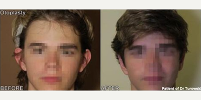 Man treated with Ear Surgery - Man treated with Ear Surgery