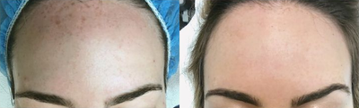 Woman treated with IPL - Woman treated with IPL