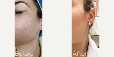 Woman treated with IPL - Woman treated with IPL